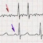 Fibrillazione ventricolare: sintomi, cause e cure