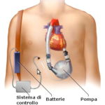 rp_Dispositivi-di-assistenza-ventricolare-VAD.png