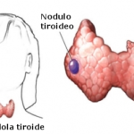 Noduli tiroidei : cause, sintomi, diagnosi e cure