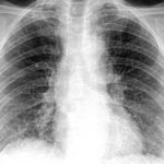 Fibrosi polmonare : sintomi, cause, diagnosi e cure