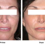 rp_prima-edopo-laser-skin-resurfacing.jpg