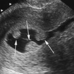 Polipi uterini : sintomi, cause, diagnosi e cure
