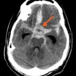 Aneurisma cerebrale : sintomi, cause, diagnosi e terapie