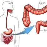 Colectomia : procedure e malattie