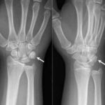 Fratture del polso e della mano : sintomi, cure e chirurgia