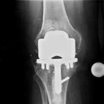 Sostituzione del ginocchio (artoplastica)