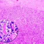 Carcinoma papillare della tiroide : sintomi, cause, cure e prognosi