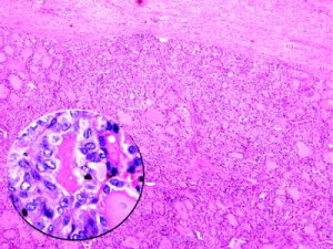 Carcinoma papillare della tiroide : sintomi, cause, cure e prognosi