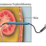 rp_Nefrolitotomia-percutanea.jpg