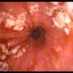 Esofagite : sintomi, cause, diagnosi e cure