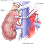 Surrenalectomia: procedura e chirurgia
