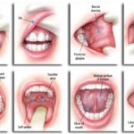 Screening per la prevenzione del cancro orale