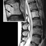 Angioma vertebrale