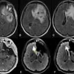 glioma