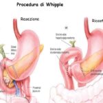 Procedura di Whipple: vantaggi e rischi