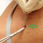 Biopsia cutanea: tecniche, rischi  e risultati