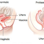 Prolasso uterino: sintomi, cause e cure