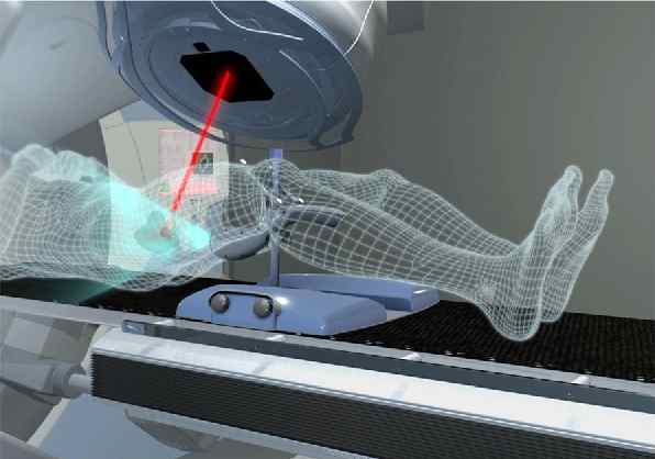 radioterapia prostata effetti collaterali prostate cancer tnm