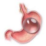 Posizionamento/Rimozione di pallone endogastrico