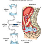 Dialisi peritoneale: rischi e benefici