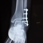 Chirurgia della caviglia: opzioni e benefici