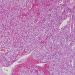 paraganglioma