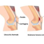 Sindrome femoro-rotulea