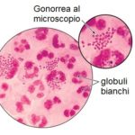 Gonorreal al microscopio