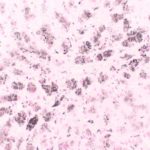 Sindrome di Dubin-Johnson