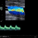 ecodoppler-fistola