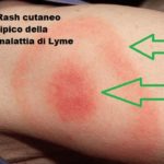 Malattia di Lyme: come riconoscerla