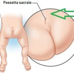 Fossetta sacrale