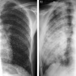 silicosi rx