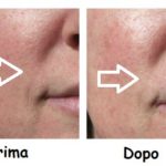 dermaplaning