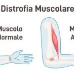 Distrofia muscolare: sintomi, tipi, diagnosi e cure disponibili image